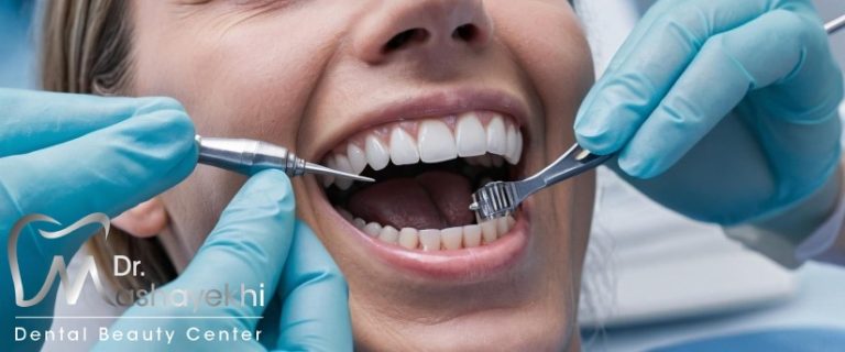 قیمت کامپوزیت دندان در سال ۱۴۰4 + فاکتورهای تأثیرگذار