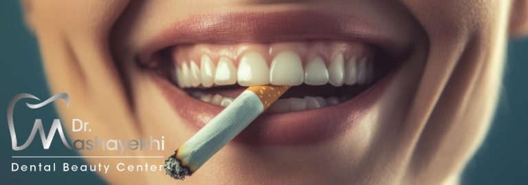 لمینت دندان برای افراد سیگاری و قهوهخور