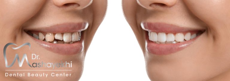 چرا لمینت دندان میشکند؟ دلایل شکستن لمینت دندان