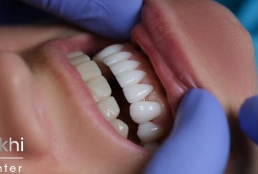 تفاوت عمر لمینت و کامپوزیت چقدر است ؟