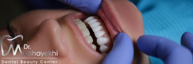 تفاوت عمر لمینت و کامپوزیت چقدر است ؟