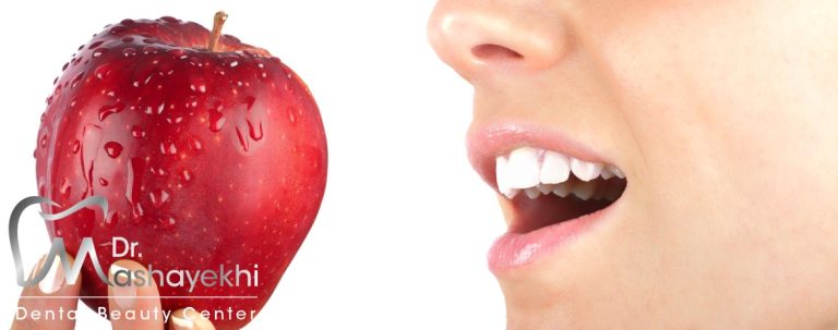 غذا خوردن بعد از لمینت دندان