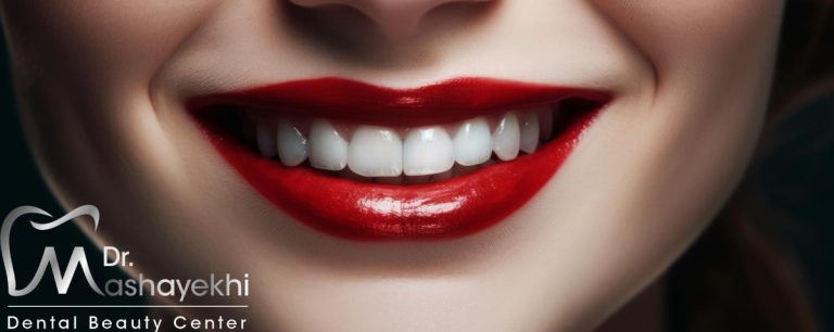 عمر لمینت دندان | بررسی کامل عوامل مؤثر بر دوام لمینت
