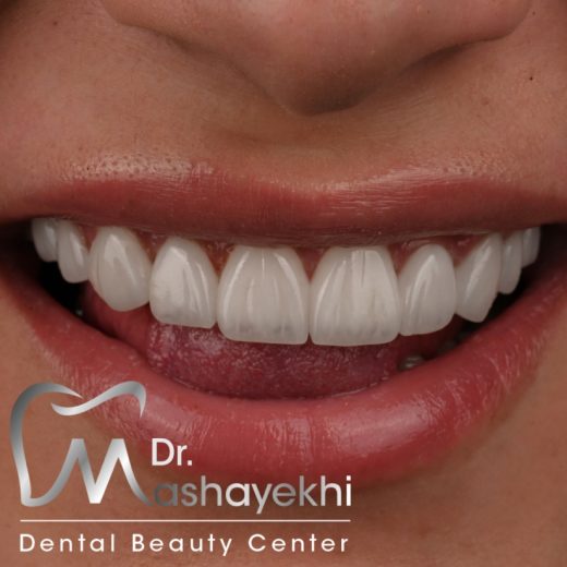 عوارض لمینت دندان و راهکار های آن