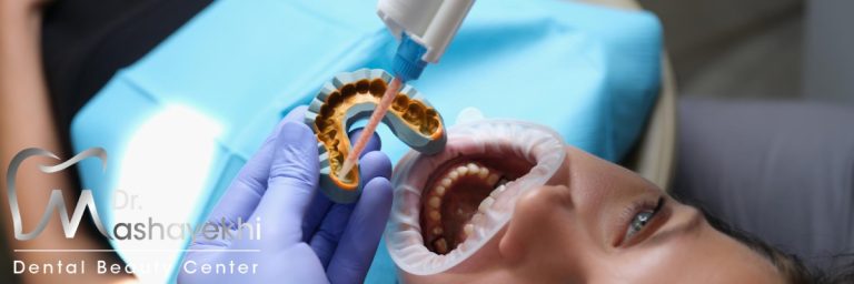 لمینت فوری دندان