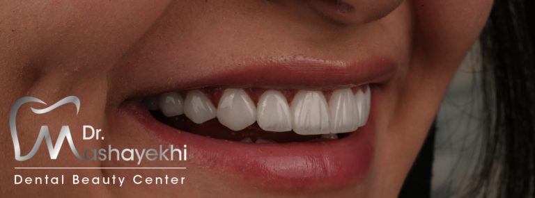 عوارض لمینت دندان و چگونگی جلوگیری از آنها