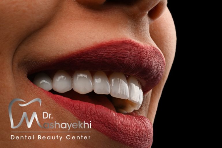 مراقبت های بعد از کامپوزیت دندان